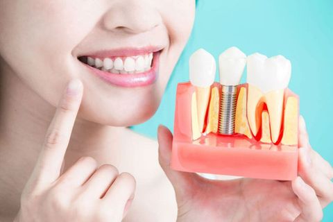 Affordable Dental Implants: Tips to Save on Your New Smile